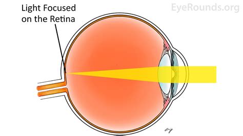 Cornea Refraction – Cornea Vs Ocular Surface – UAIQMW