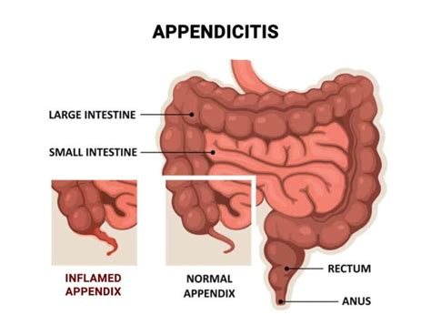 Image result for Appendix Example Website