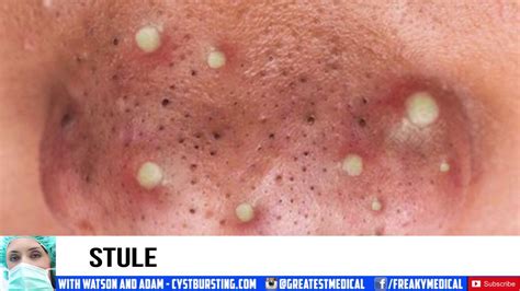 Image result for Largest Infected Exploding Cyst Carbuncle Blackhead