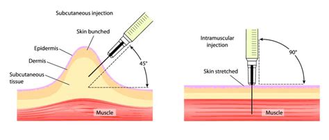 Image result for SubQ Injection Technique