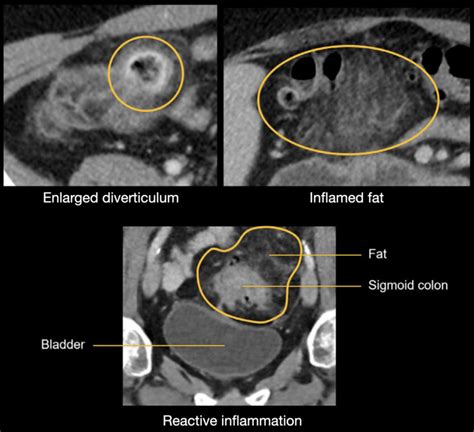 Image result for Colonic Diverticulum CT