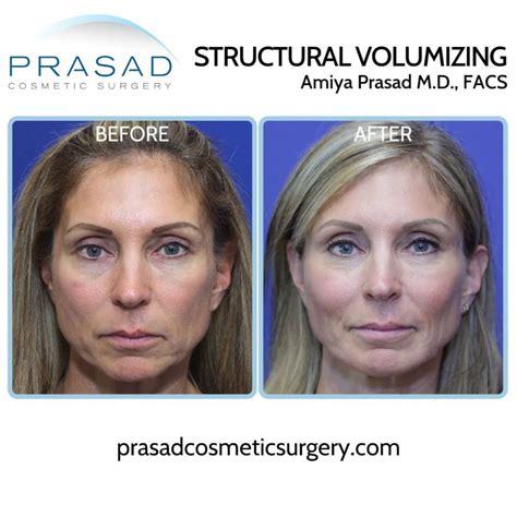 Face Symmetry Surgery