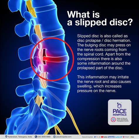 Slipped Disc Pain Medication