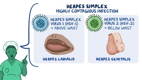 Video: Herpes simplex virus (HSV): Nursing | Osmosis