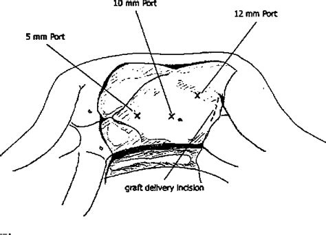 Image result for Hand-Assisted Nephrectomy