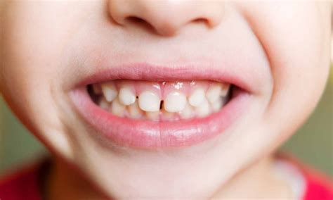 Hard evidence of soft teeth: the oral symptoms of hypophosphatasia