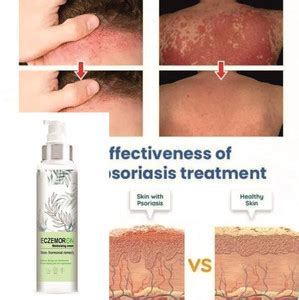 house of common Eczemaron Anti Fungal Cream For Men & Women (100ml ...