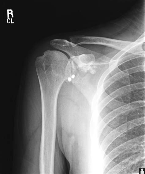 Shoulder Joint Arthritis X Ray at Rosa Feemster blog