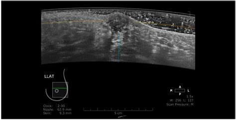 Pros and Cons for Automated Breast Ultrasound (ABUS): A Narrative Review