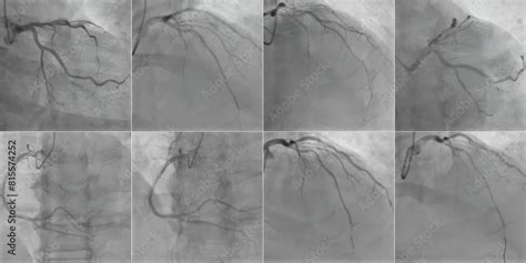 Coronary Angiogram Procedure 的图像结果