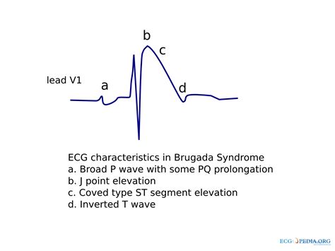 Brugada Ecg