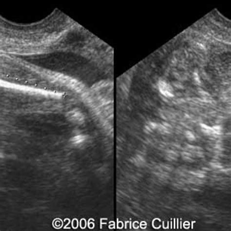 📃 Jarcho-Levin syndrome with caudal regression