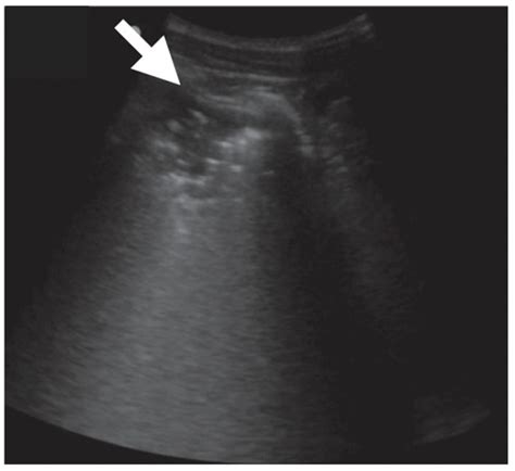 The Role of Ultrasound in the Diagnosis of Pulmonary Infection Caused ...