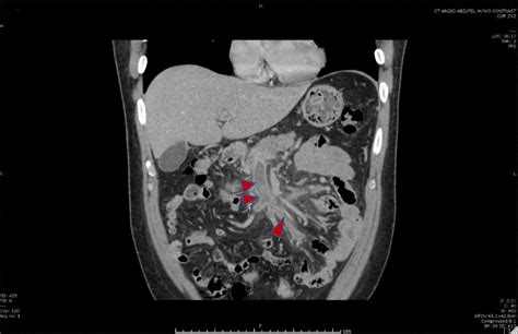 Superior Mesenteric Vein Thrombosis