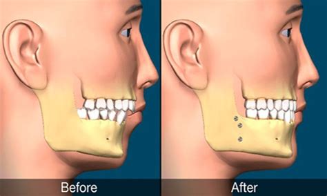 Corrective Jaw Surgery in Mumbai: Transforming Smiles and Functionality