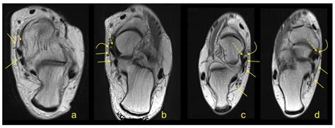 The Flexor Retinaculum Connects the Surrounding Structures into the ...