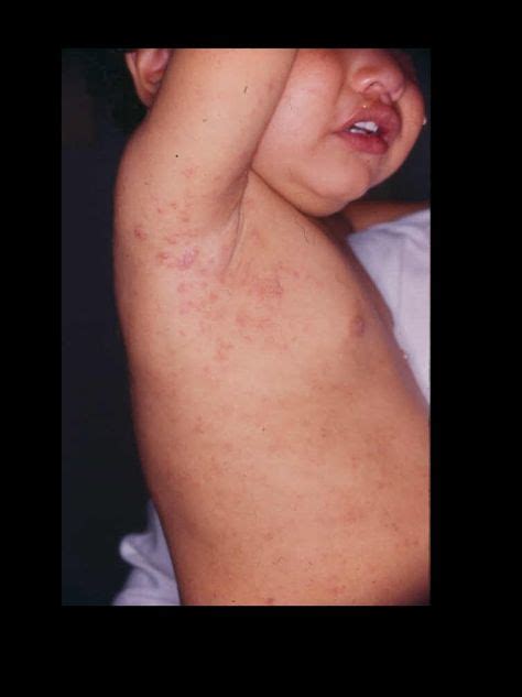 scabies worse at night