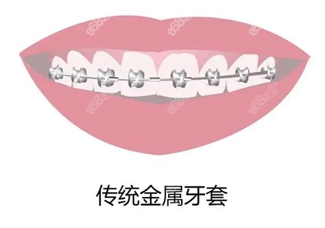 牙套多少钱价格表2022:含金属/隐形/矫正牙套及烤瓷牙套价格,烤瓷牙-8682赴韩整形网