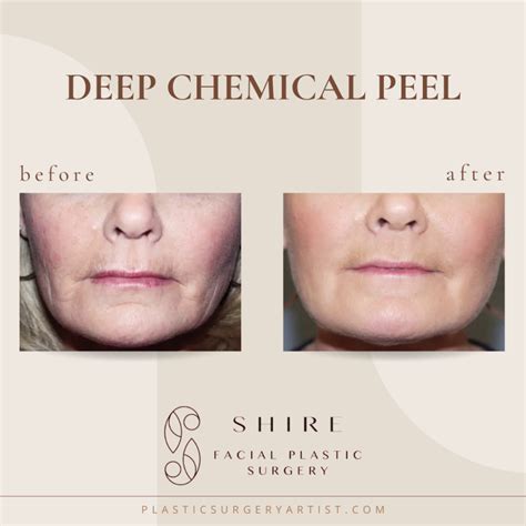 Phenol Croton Oil Peel Chattanooga | Deep Chemical Peels