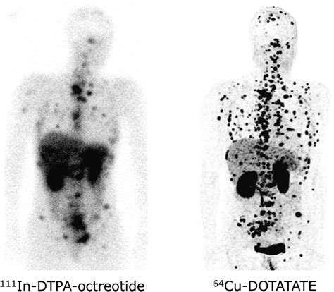 Clinical PET of Neuroendocrine Tumors Using 64Cu-DOTATATE: First-in-Humans Study | Journal of ...