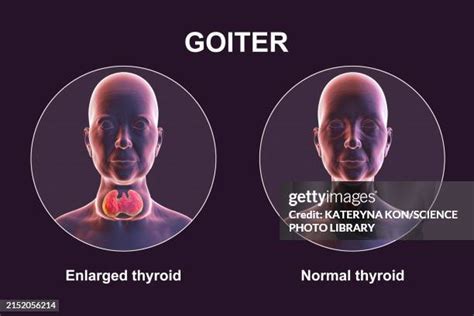 Image result for Thyroid Function Algorithm