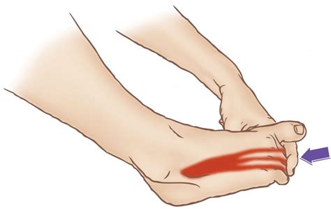 Extensor Digitorum Exercises 的图像结果