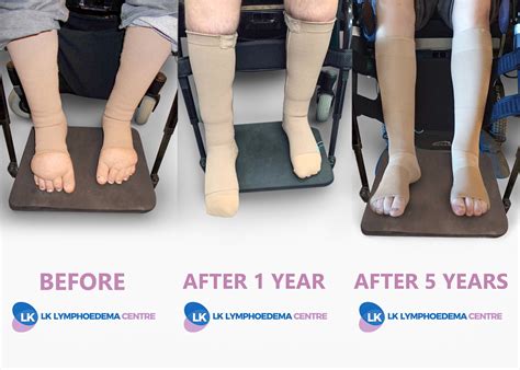 Edema Compression Socks Before And After at Loren Griffith blog