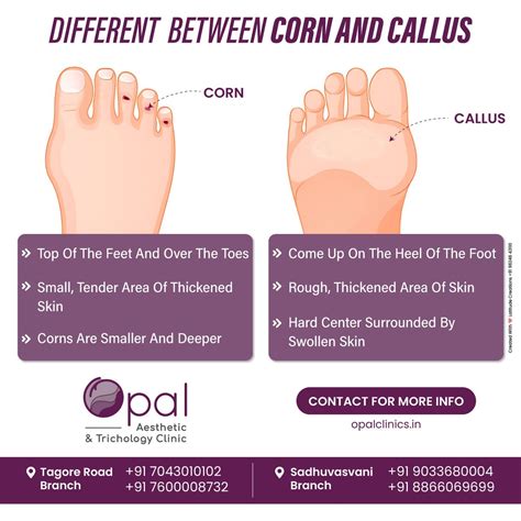 Difference Between A Corn And A Callus On Your Foot on Sale | emergencydentistry.com