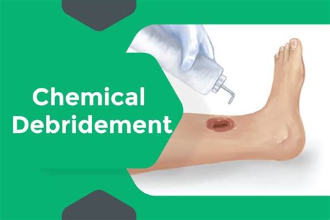 Chemical Debridement for Diabetic Foot Ulcers in Surat