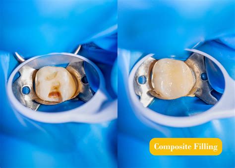 Composite Fillings | Lighthouse Dental Centre | Langley