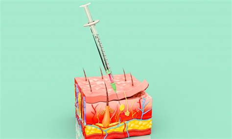 Image result for Subcutaneous Injection Procedure