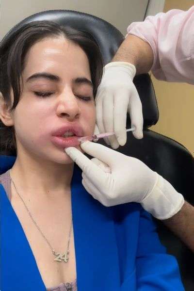 Urfi Javed Face Swelling: The Truth Behind Her Lip Fillers Being Dissolved