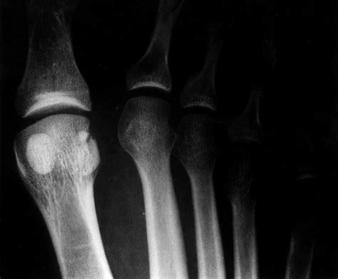 Sesamoid Bone Fracture