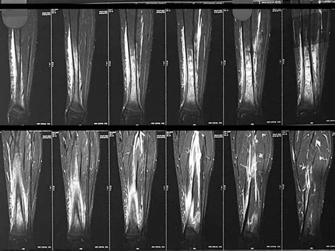 Chronic Recurrent Multifocal Osteomyelitis - a care report.pptx