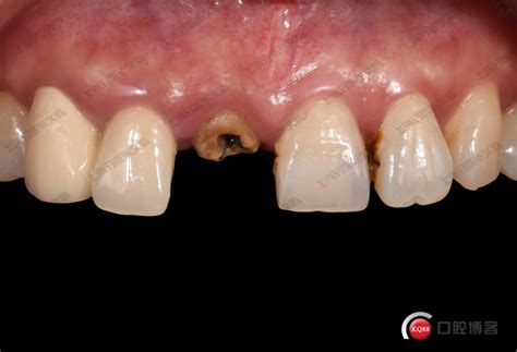 【病例展示】——上颌前门牙即刻种植病例分享-张文鑫的博客-KQ88口腔博客