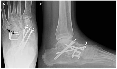 X Ray Hindfoot Fusion