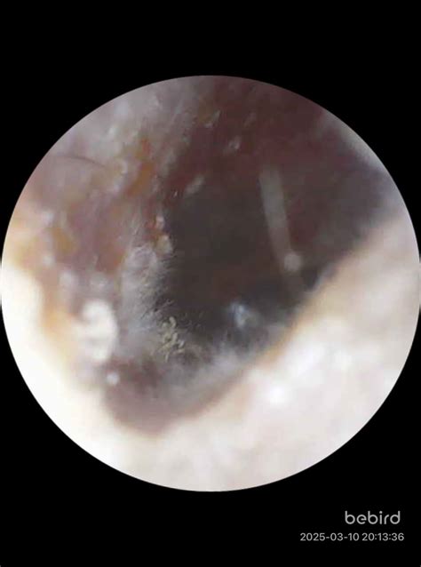 Otomycosis: a common fungal ear infection | Maryam Ghorbani posted on ...
