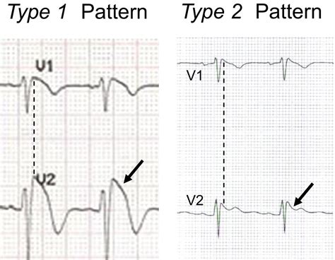 Brugada Syndrome: Diagnostic Pitfalls - Journal of Emergency Medicine