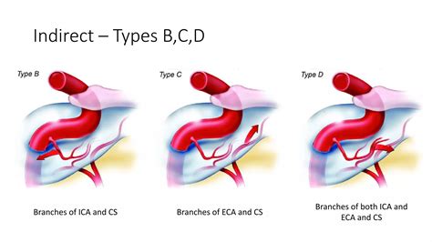 Carotid Cavernous Fistulas | PPTX
