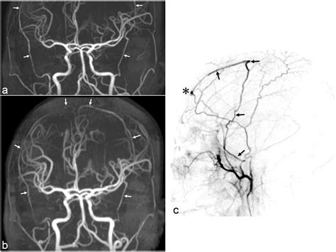 Diagnosis of a Dural Arteriovenous Fistula Involving the Superior ...