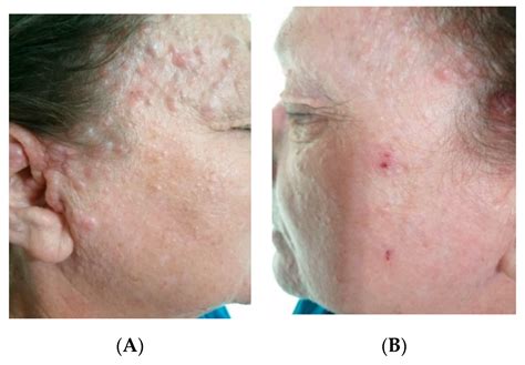 Observations on Four Cases of Brooke–Spiegler Syndrome