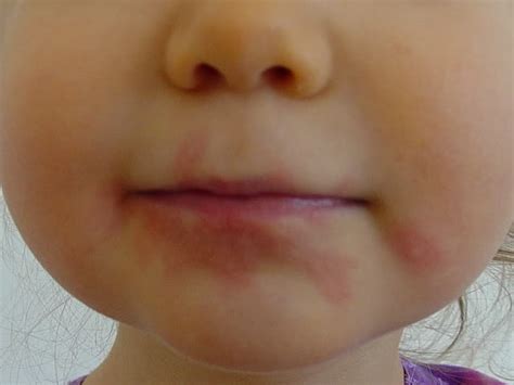 Peanuts Allergy: Preventive Treatment [1 min read]