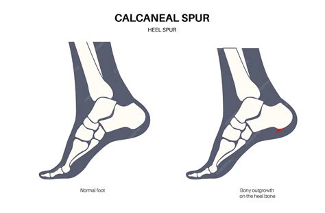 Premium Vector | Calcaneal spur anatomy Foot problem diagnostic and ...