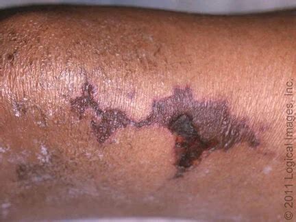 Rash Pictures SJS 的图像结果