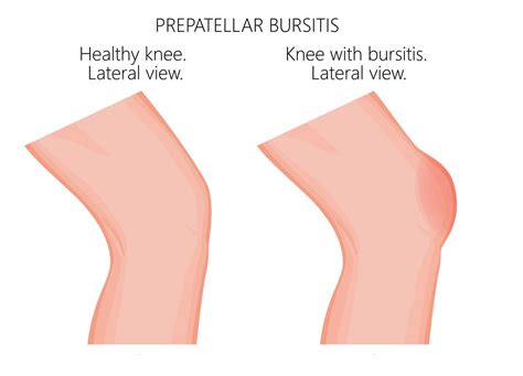 Knee Bursitis | 7 Treatment Tips | Jeremy Burnham, MD
