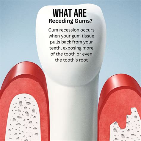 Receding Gums Causes and Treatment