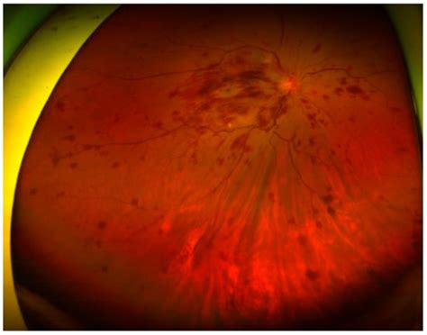 Rare Orbital Metastasis Originating from Ampullary Adenocarcinoma