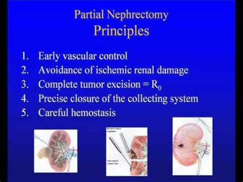 Image result for Open Nephrectomy Procedure