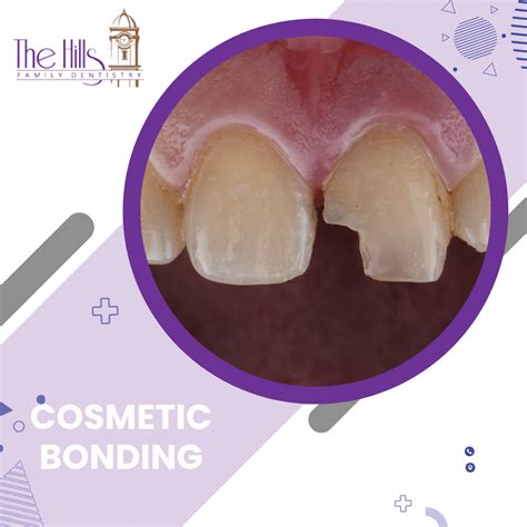 Cosmetic Dental Bonding - The Hills Family Dentistry - Have a Chipped Tooth?