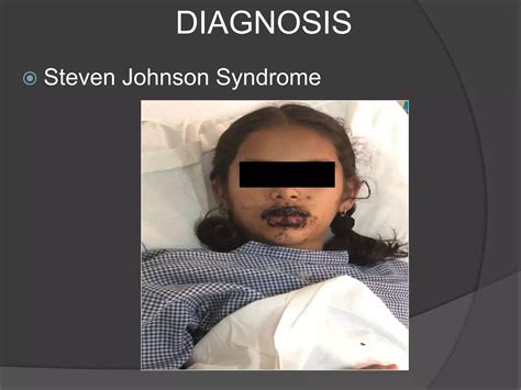 Adverse Drug Reaction: Steven Johnson Syndrome | PPTX